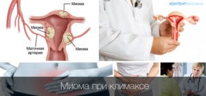 Признаки миомы в менопаузу