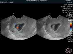 На какой неделе слышно сердцебиение плода на узи
