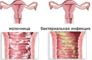 Молочница при зачатии последствия