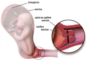 Матка короткая при беременности
