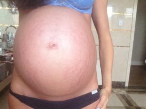 Что делать чтобы при беременности не было растяжек