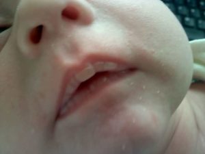 Мозоли у новорожденного на губах