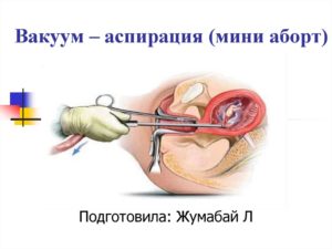 Вакуум аспирация как проходит