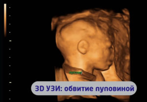 Обвитие пуповиной вокруг шеи на 20 неделе беременности
