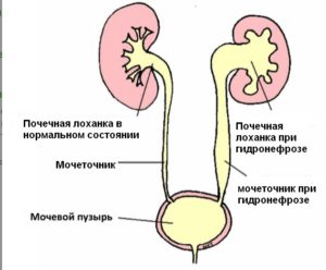 Расширение лоханки при беременности