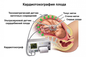 При тонусе матки капельница