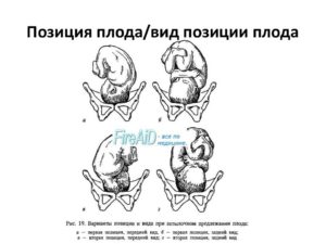 Головное предлежание плода 1 позиция передний вид