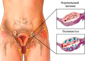 Расположение яичников при беременности