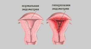 Сильные месячные после родов