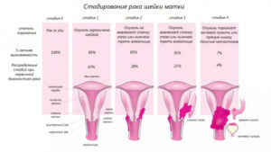 Беременность после рака матки