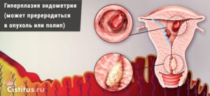 Гиперплазия эндометрия что это такое при климаксе лечение