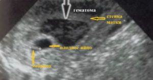 Субхорионическая гематома при беременности