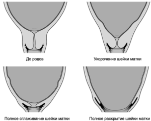 Как в домашних условиях определить раскрытие шейки матки