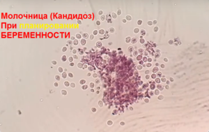 Молочница при зачатии последствия
