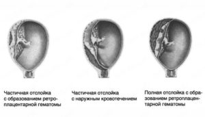 Отслойка плаценты на ранних сроках беременности лечение форум