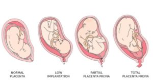 Плацента расположена по передней стенке матки высоко