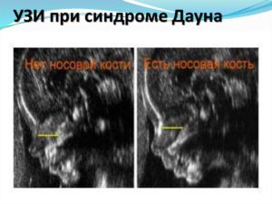 Можно ли увидеть дцп на узи при беременности