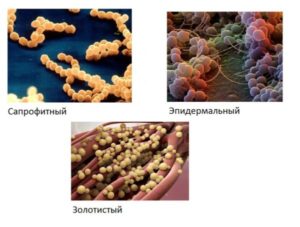 Стафилококк сапрофитный при беременности