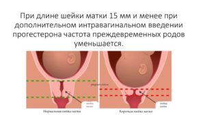 Матка короткая при беременности