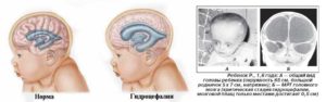 Вентрикуломегалия лечение у плода