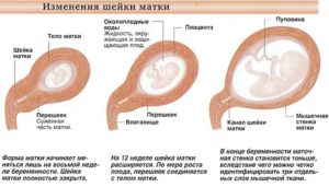 Состояние матки при беременности