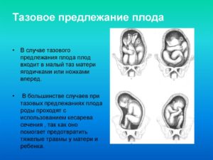 Что такое тазовое предлежание плода в 20 недель