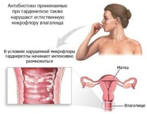 Лечение гарднереллы у беременных