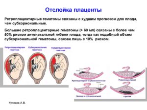 Как проявляется отслойка плаценты во втором триместре