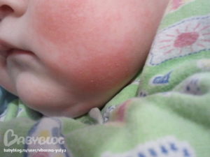 Аллергия на порошок у новорожденного