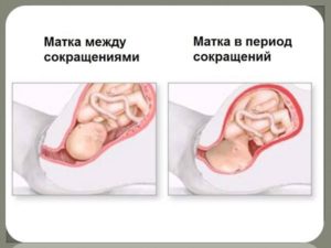 Как быстро избавиться от тонуса матки при беременности