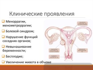 Признаки миомы в менопаузу