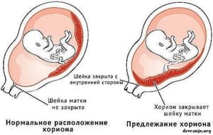 Хорион перекрывает внутренний зев на 12 неделе беременности
