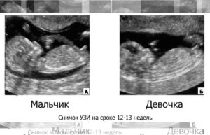 Определение пола ребенка в 13 недель по узи