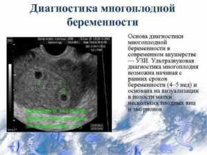 Когда можно определить многоплодную беременность