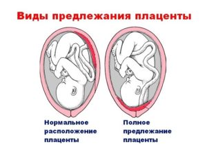 Плацента расположена по задней стенке матки в дне