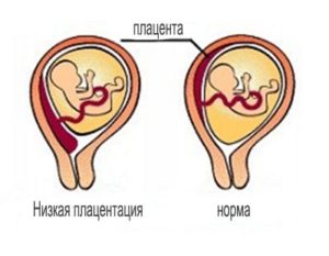 Тонкая плацента при беременности