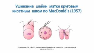 На каком сроке зашивают шейку матки при беременности