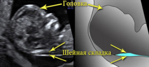 Дцп можно ли выявить при беременности на узи
