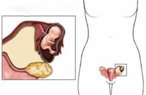 Расположение яичников при беременности