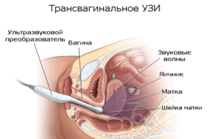 Трансвагинальное узи на какой день