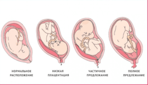 Низкая плацентация и роды