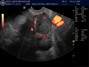Свободная жидкость в яичнике