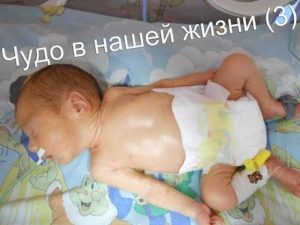 Отошли воды 29 недель