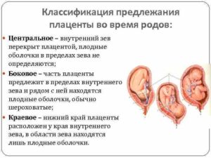 Хорион по передней стенке до края внутреннего зева