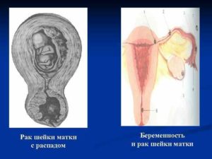 Беременность после рака матки