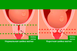 Что значит длинная шейка матки при беременности