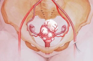 Беременность после удаления миомы