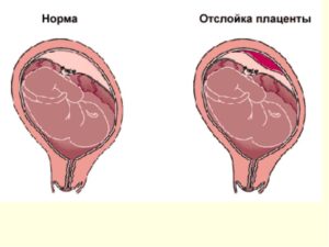 Отошла плацента при беременности