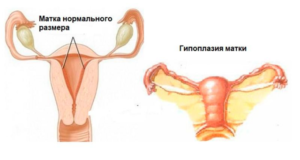 После родов маленькая матка