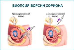 Биопсия хориона что это такое